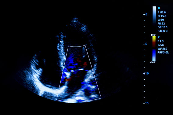 echocardiographie